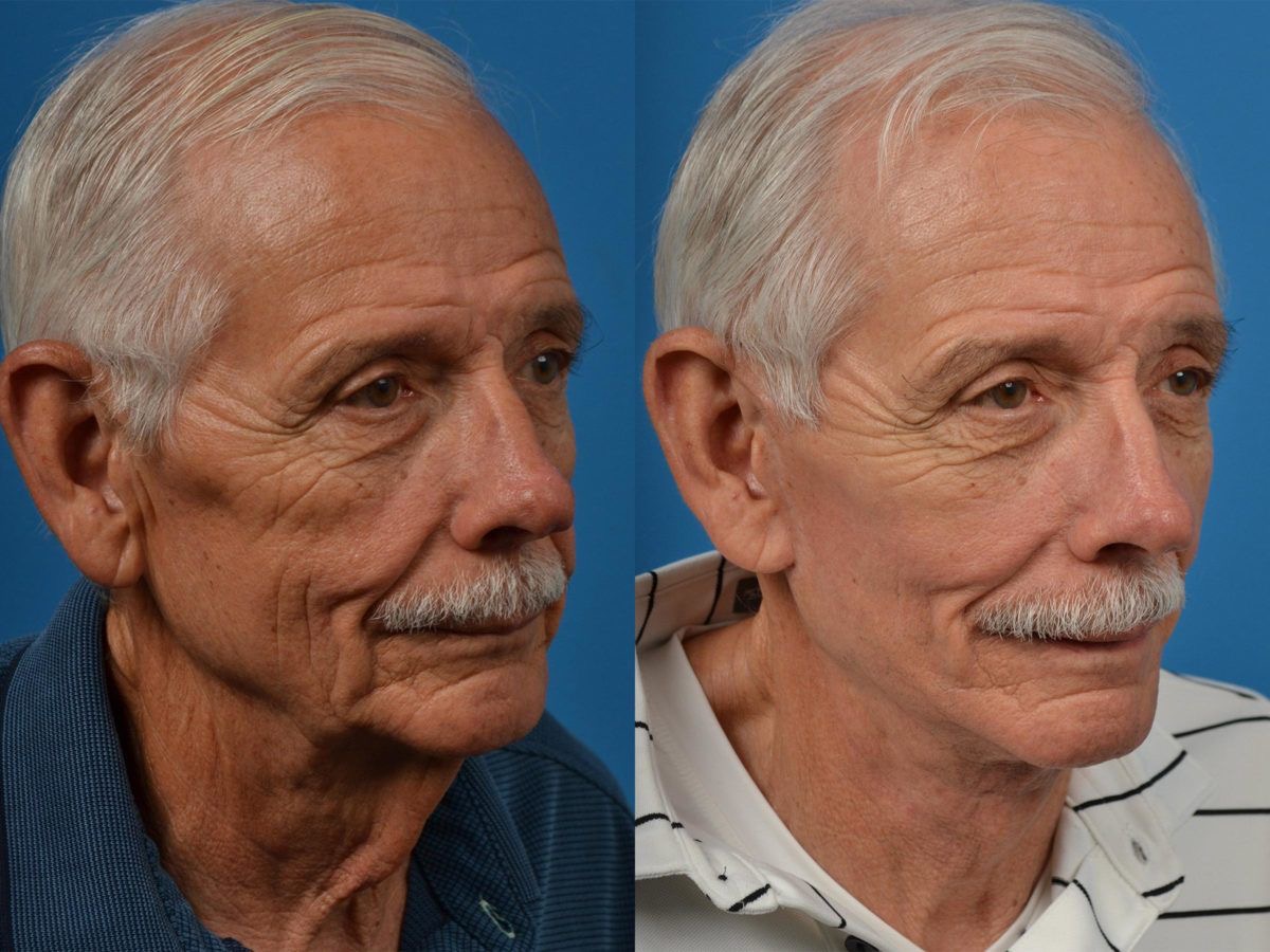 Non-surgical facial lift before and after